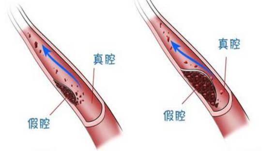 血管夾層是什么病？