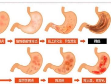 胃潰瘍出血飲食要注意些什么呢？